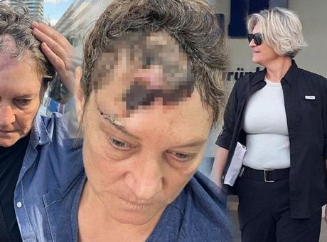 Emekli Polis, İş Adamının Köpeği Tarafından Saldırıya Uğradı: 'Ruhen Öldüm, Sadece Nefes Alıyorum'