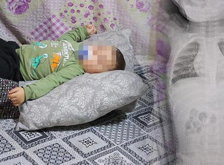 Tomografide Şok Edici Gerçek: Bebeğin Vücudunda Zımba Teli Bulundu