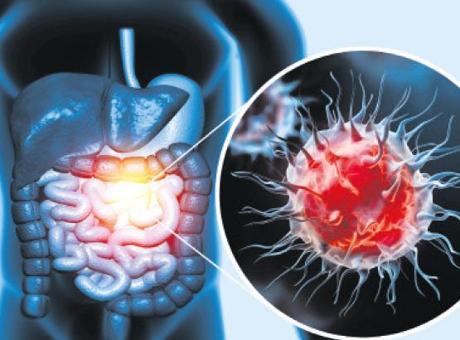 50 Yaş Altında Kolorektal Kanser Vaka Sayısında Artış!