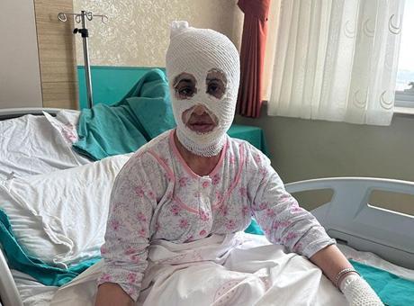 İftar Sofrasında Düdüklü Tencere Faciası: Genç Anne Yüzünde Ciddi Yanıklarla Hastaneye Kaldırıldı