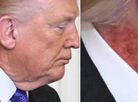 Trump’ın Boynundaki Kızarıklığın Nedeni Açıklandı