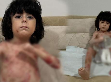 Kelebek Hastalığı ile Mücadele Eden Ailenin Zorlu Yaşamı: Yardım Çığlığı