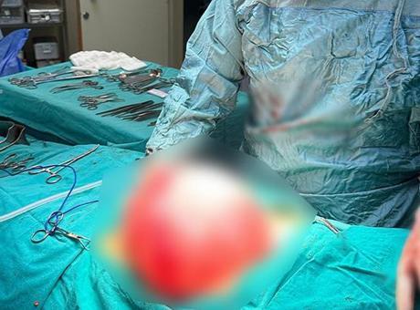 14 Yaşındaki Genç, Kilo Vermek İçin Gittiği Hastanede Karnından 3,5 Kilogramlık Kist Çıkarıldı