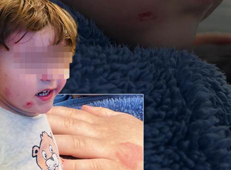 Gemlik'te Kreş Skandalı: 2,5 Yaşındaki Çocuk Darp Edildi