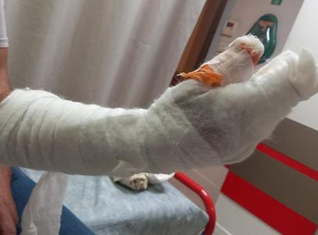 Kocaeli'de Sağlık Skandalı: Tedavi Sürecinde Parmağı Ampute Edildi, Kolunda Metal Parça Bulundu