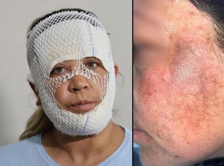 Adana'da Prenses Cilt Bakımı Kabusu: Yüzünde Yanıklarla Hastaneye Gitti