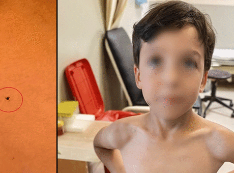 7 Yaşındaki Çocuğun Göğsüne Kene Yapıştı: Sağlık Ekipleri Anında Müdahale Etti