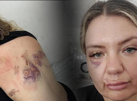 Özge Çelik'in Dehşet Anları: Bıçak Saldırısına Uğradım, Şansım Kırıldı