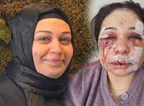 Yüzüne 60 dikiş atılmıştı! Eşini darbeden polis memuru tahliye edildi