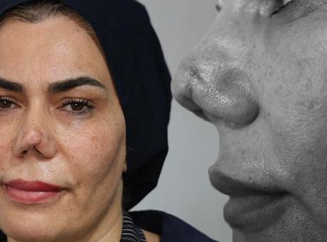 Burnu kırıldı, 4 operasyon sonrası hayatı kabusa döndü: Resmen hayattan koptum